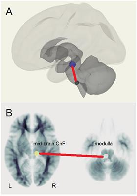 Altered brain connectivity in Long Covid during cognitive exertion: a pilot study